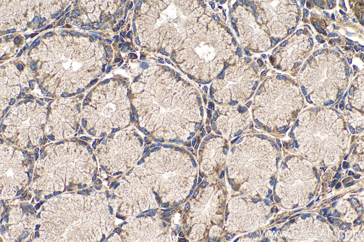 IHC staining of human stomach cancer using 25626-1-AP