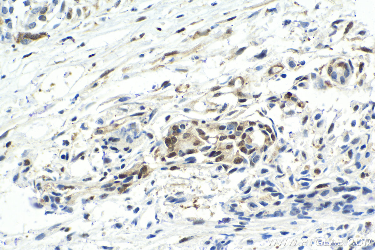 IHC staining of human pancreas cancer using 21357-1-AP