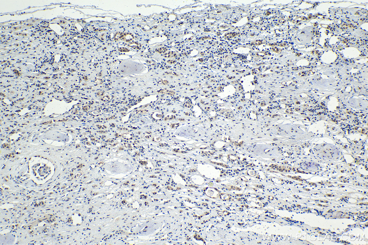 IHC staining of human renal cell carcinoma using 21357-1-AP