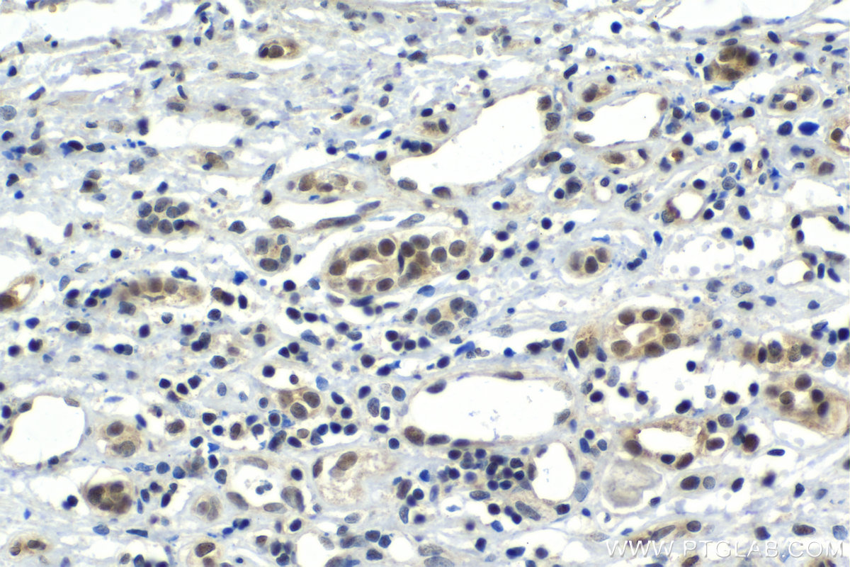 IHC staining of human renal cell carcinoma using 21357-1-AP