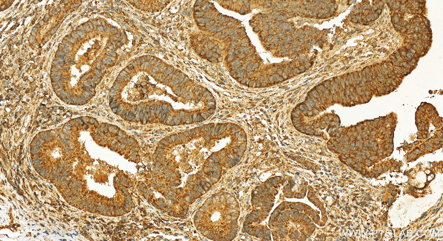 IHC staining of human colon cancer using 25576-1-AP