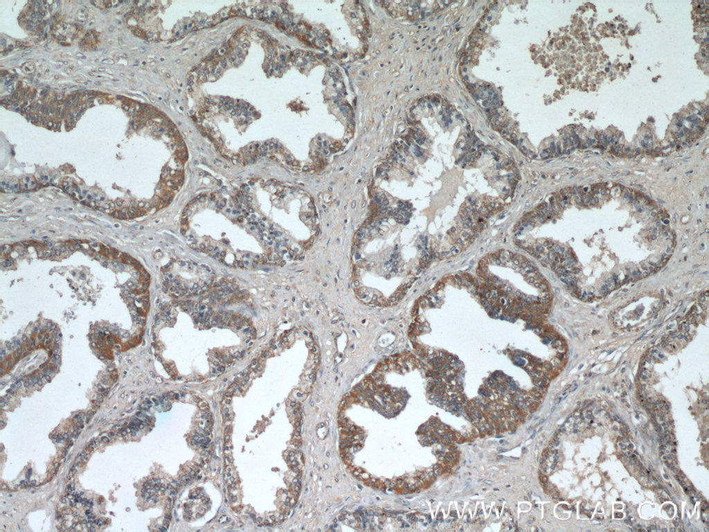 IHC staining of human prostate hyperplasia using 20913-1-AP