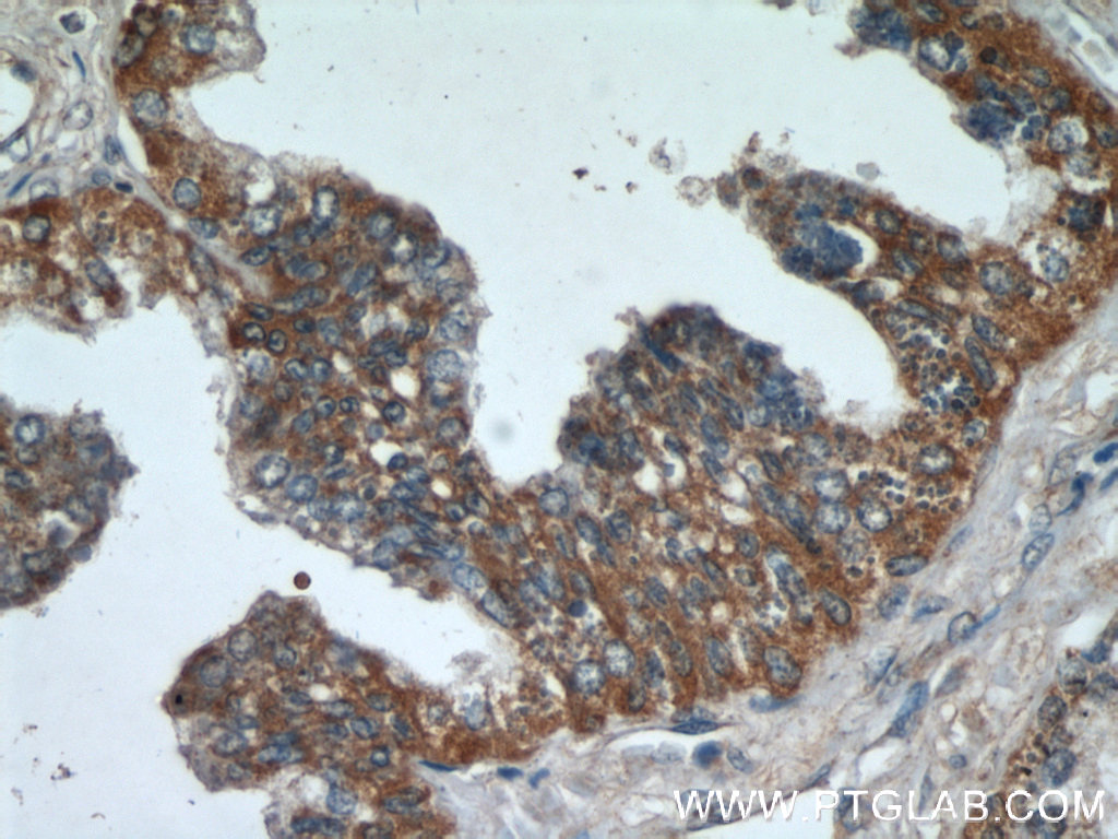 IHC staining of human prostate hyperplasia using 20913-1-AP