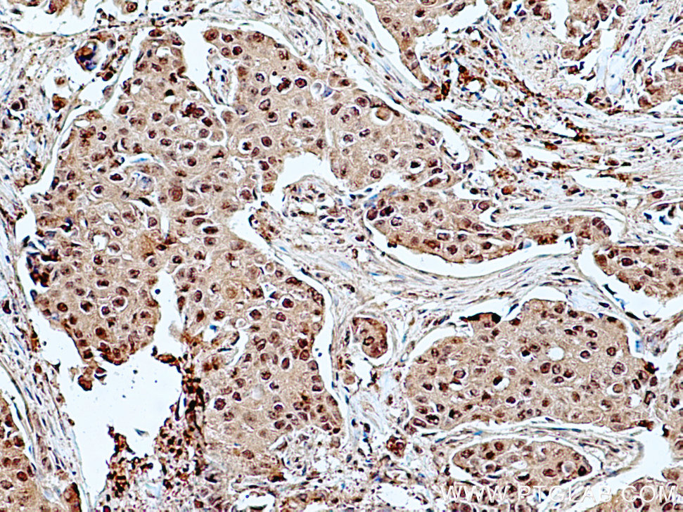 IHC staining of human breast cancer using 25124-1-AP