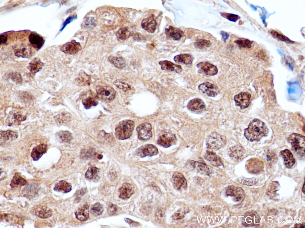 IHC staining of human breast cancer using 25124-1-AP