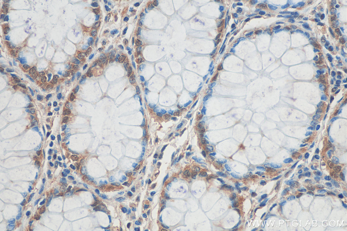 IHC staining of human colon cancer using 24690-1-AP