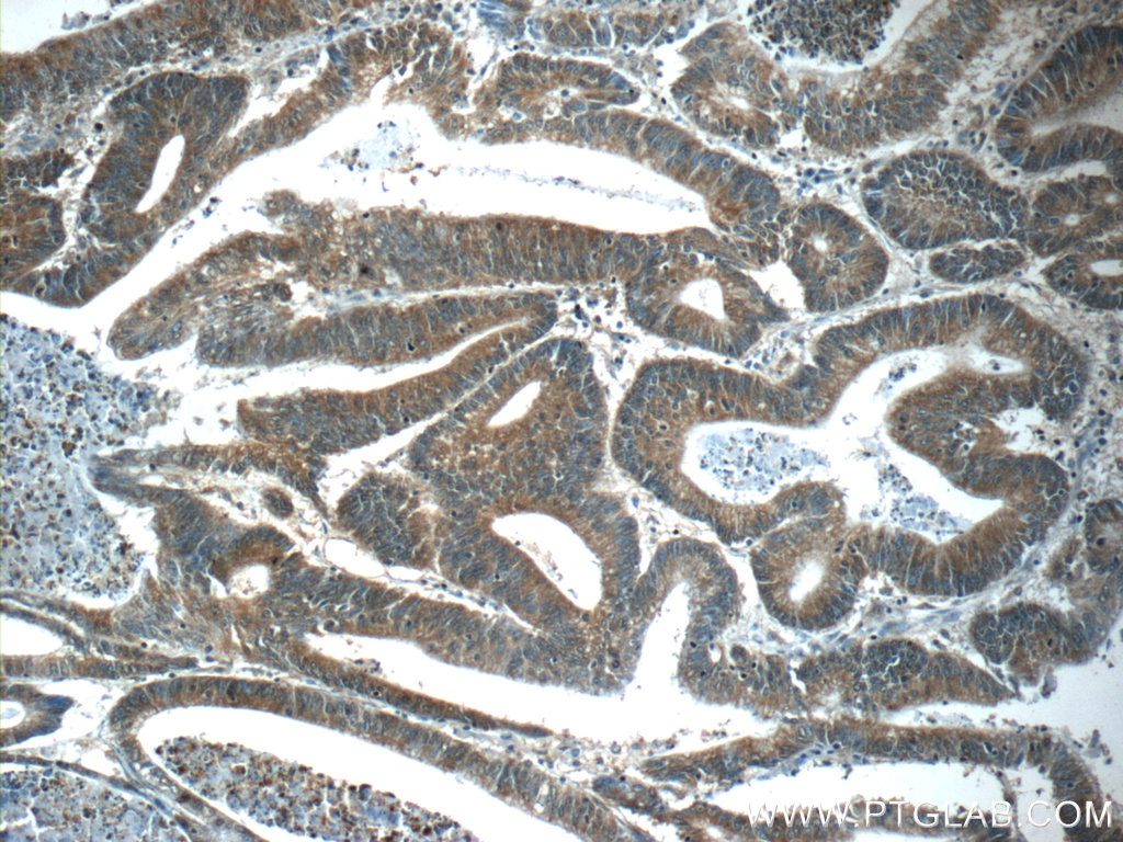 IHC staining of human colon cancer using 24549-1-AP