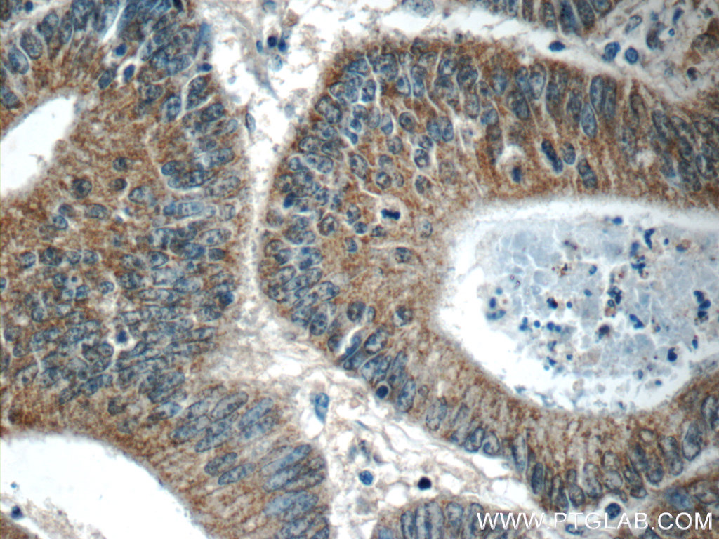 IHC staining of human colon cancer using 24549-1-AP