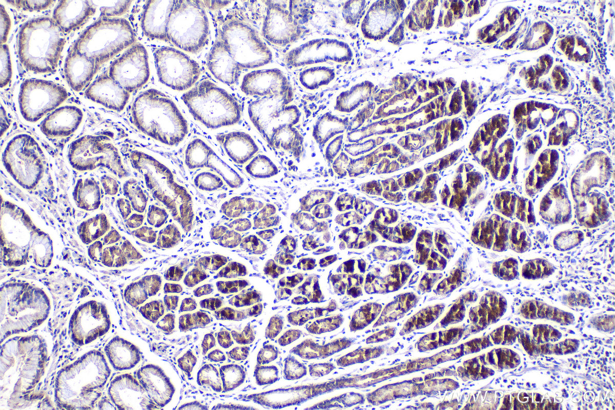 IHC staining of human stomach cancer using 21593-1-AP