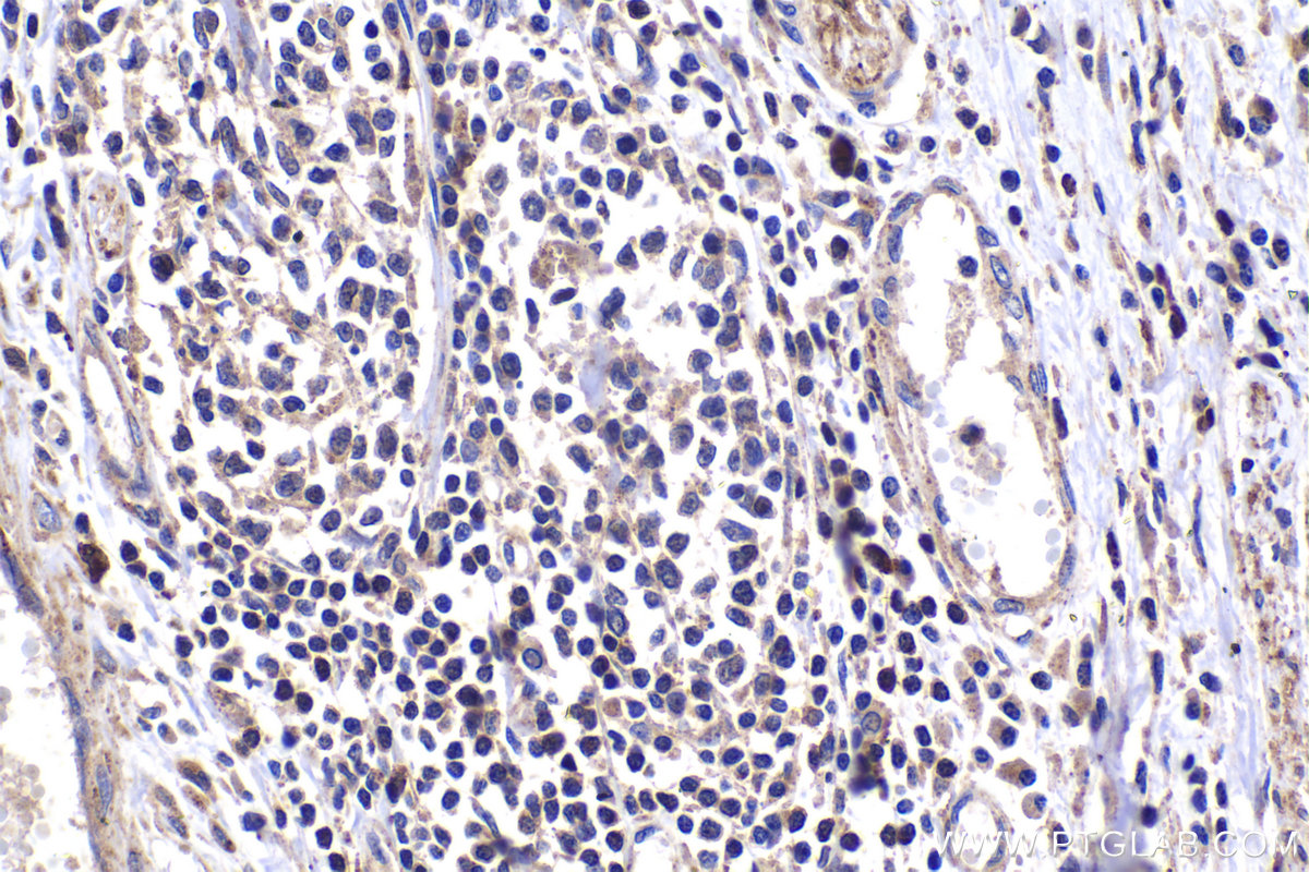 IHC staining of human cervical cancer using 21593-1-AP