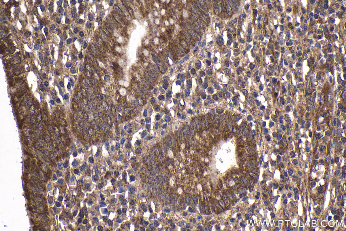 IHC staining of human appendicitis using 25757-1-AP