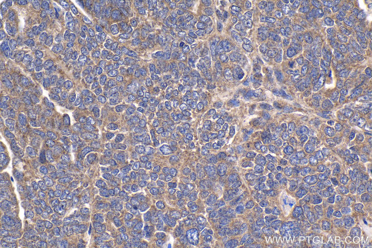 IHC staining of human ovary tumor using 25757-1-AP