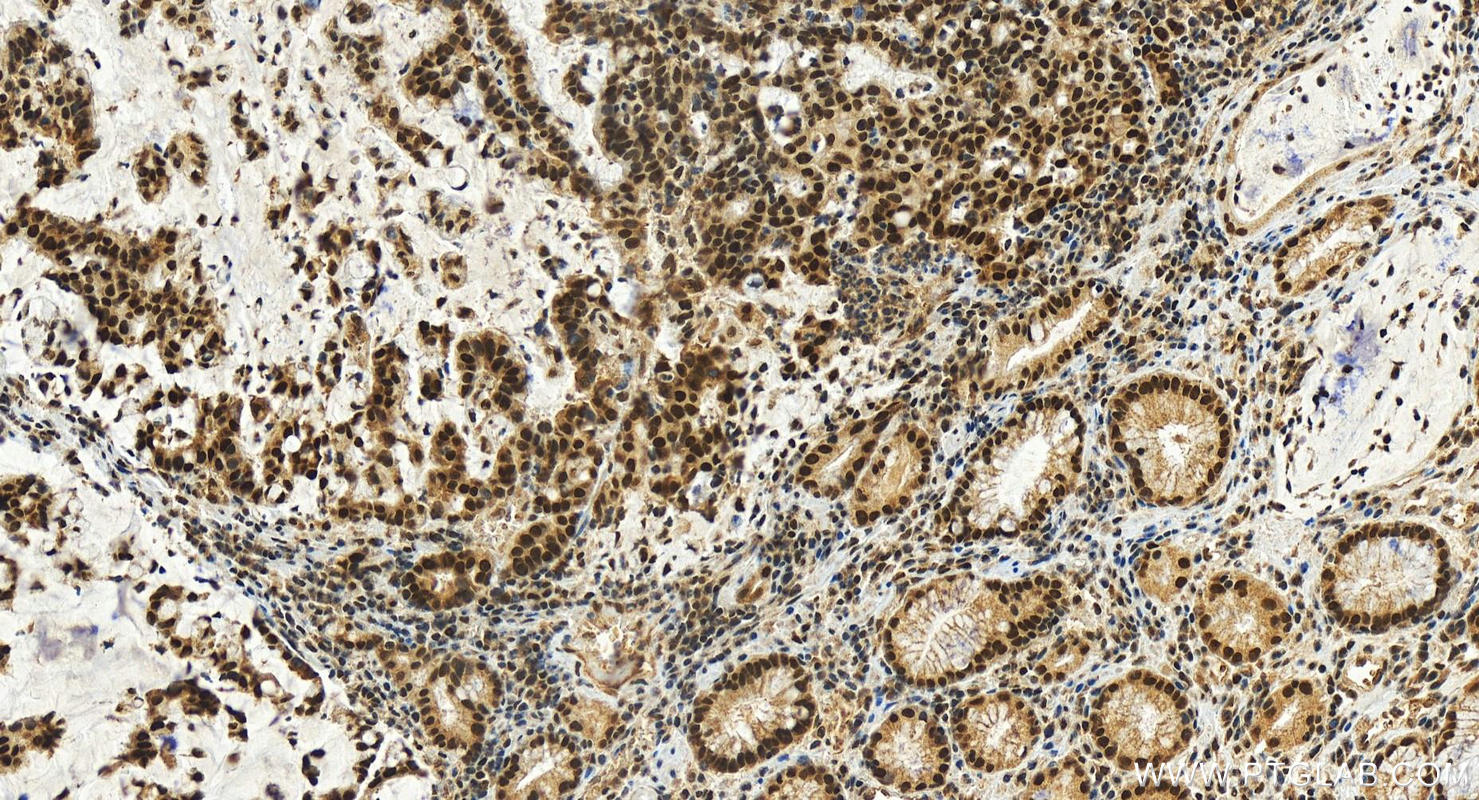 IHC staining of human stomach cancer using 14496-1-AP