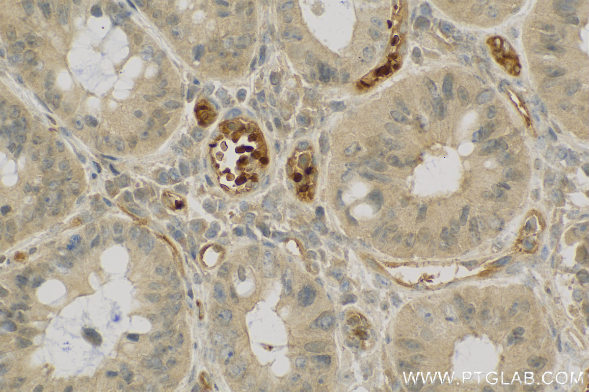 IHC staining of human colon cancer using 13198-2-AP