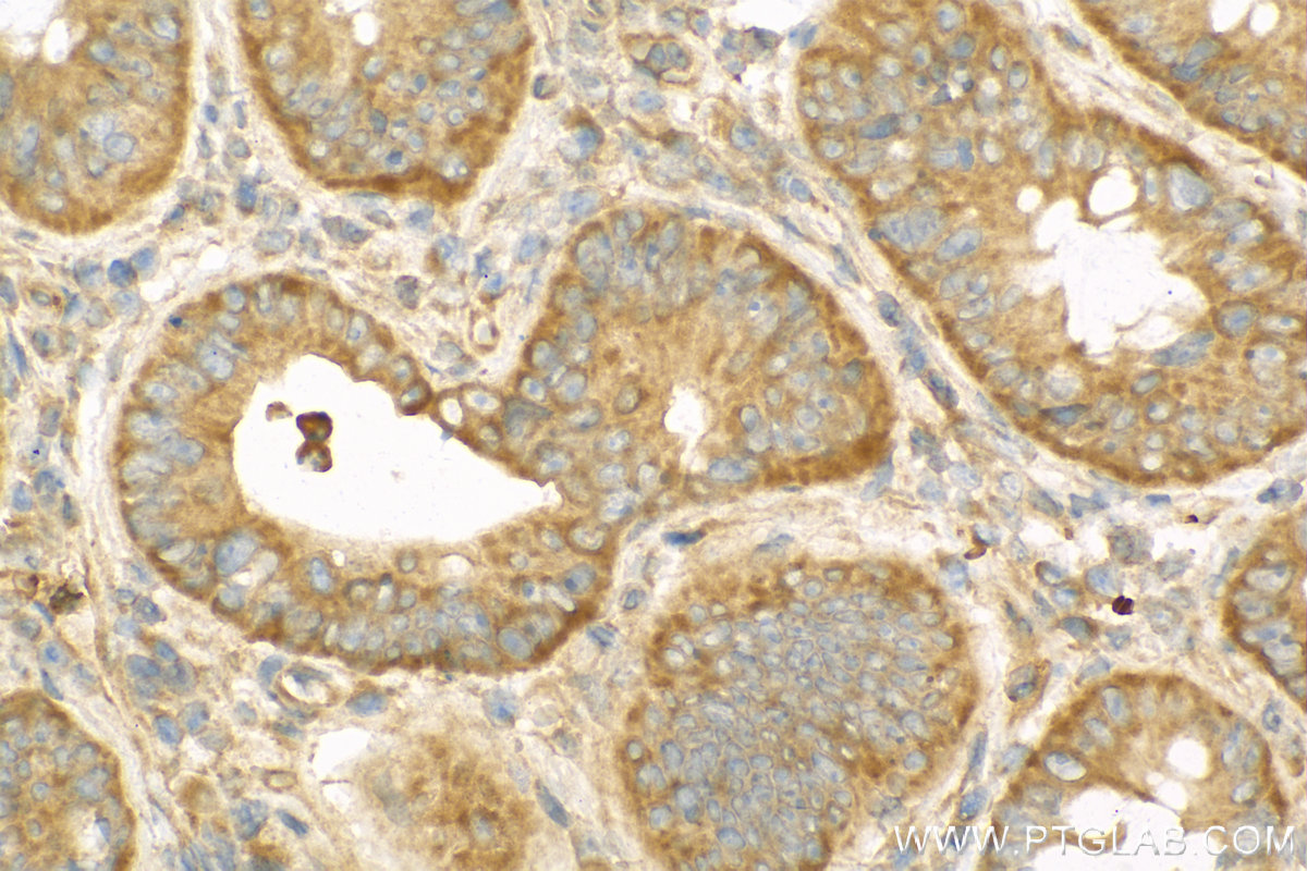 IHC staining of human colon cancer using 13931-1-AP