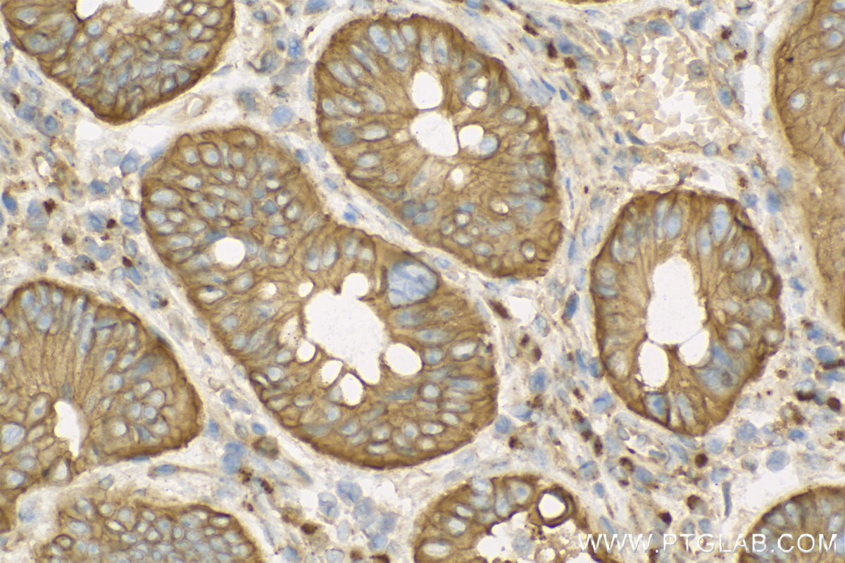 IHC staining of human colon cancer using 13931-1-AP