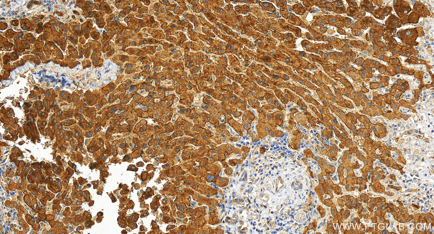 IHC staining of human intrahepatic cholangiocarcinoma using 14335-1-AP