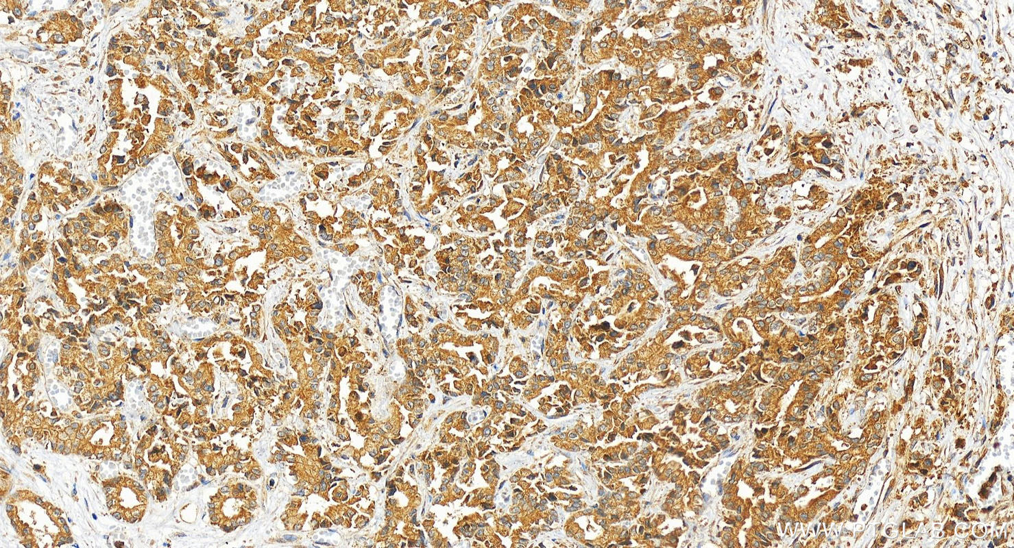 IHC staining of human intrahepatic cholangiocarcinoma using 14335-1-AP