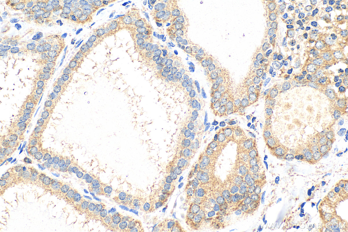 IHC staining of human thyroid cancer using 68774-1-Ig