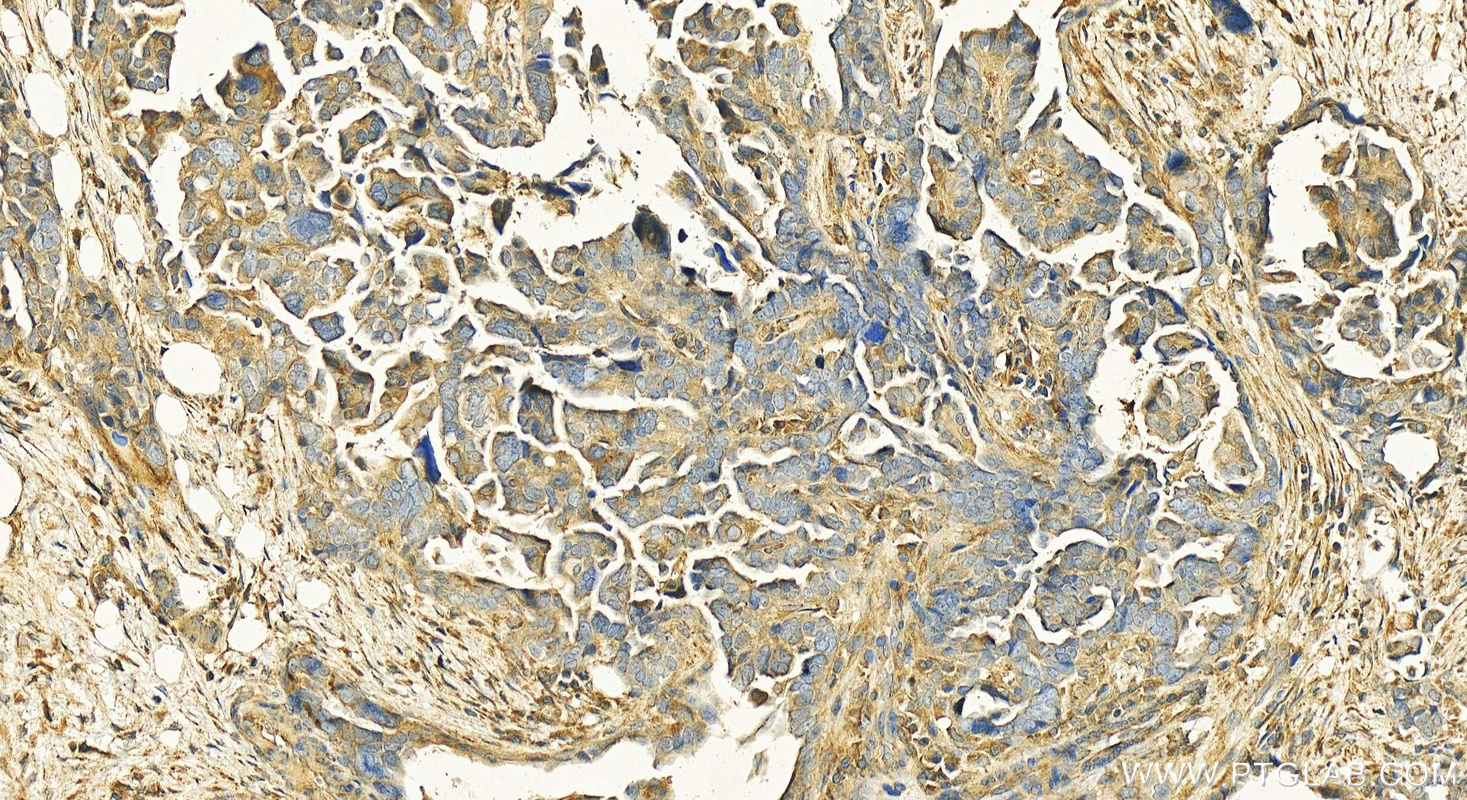 IHC staining of human ovary cancer using 12229-1-AP