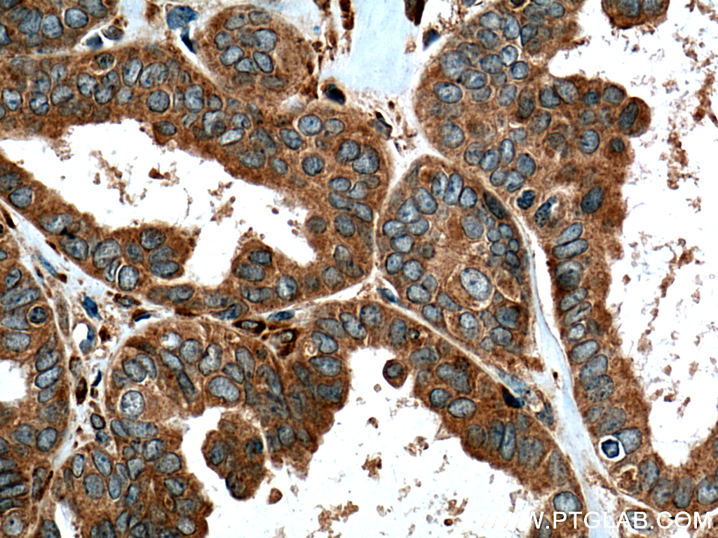 IHC staining of human ovary tumor using 13263-1-AP