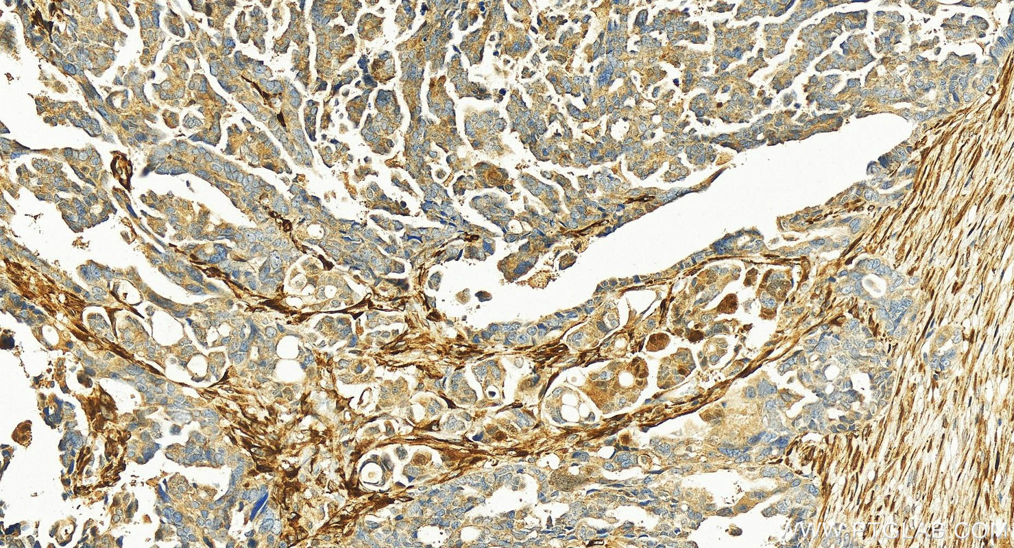 IHC staining of human ovary cancer using 13263-1-AP