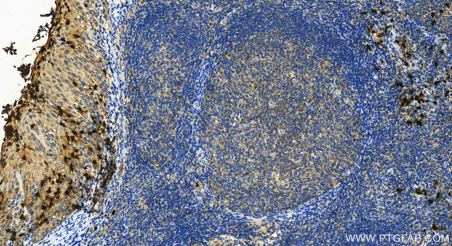 IHC staining of human tonsillitis using 12009-1-AP