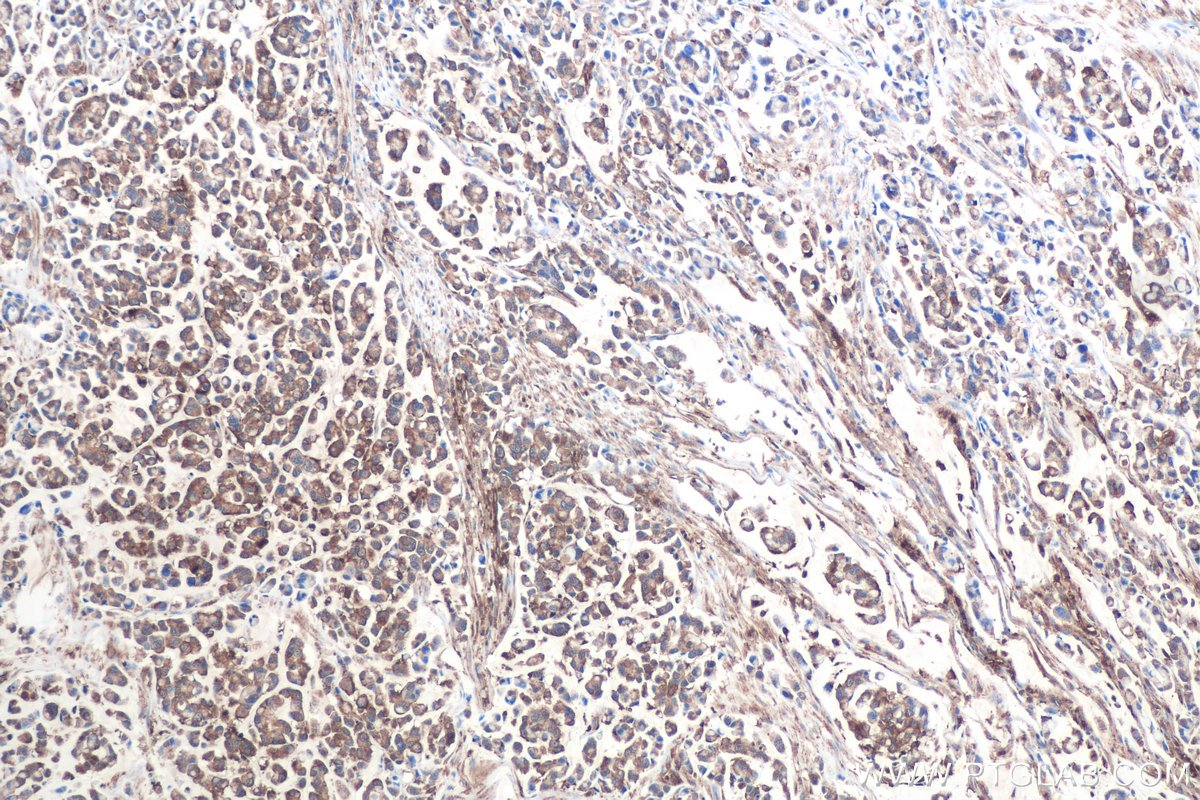 IHC staining of human colon cancer using 68207-1-Ig (same clone as 68207-1-PBS)