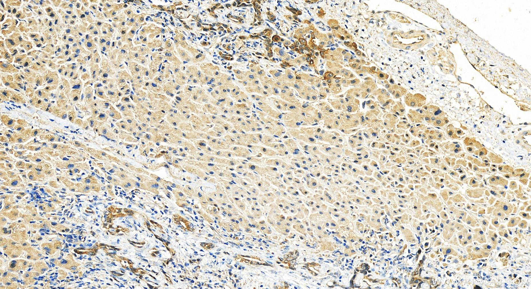 IHC staining of human intrahepatic cholangiocarcinoma using 10120-1-AP