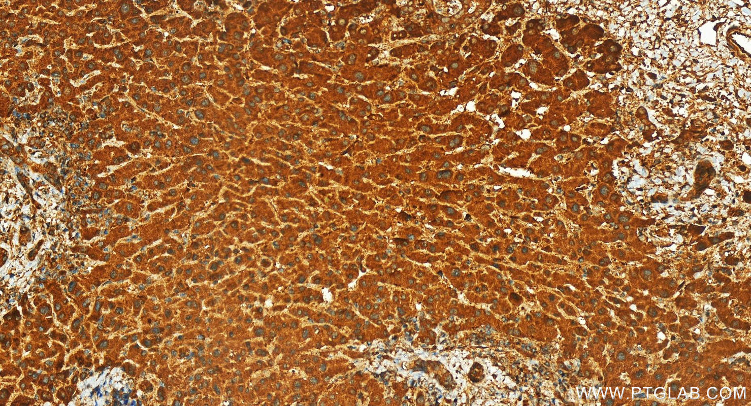 IHC staining of human intrahepatic cholangiocarcinoma using 13870-1-AP