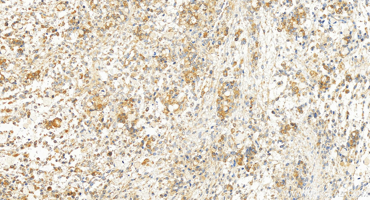 IHC staining of human ovary cancer using 13870-1-AP