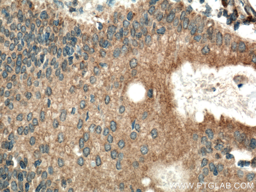 IHC staining of human stomach cancer using 20971-1-AP