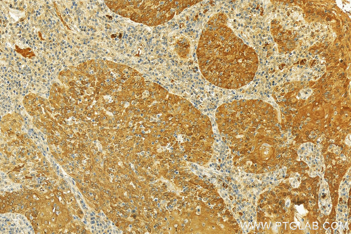 IHC staining of human skin cancer using 15803-1-AP