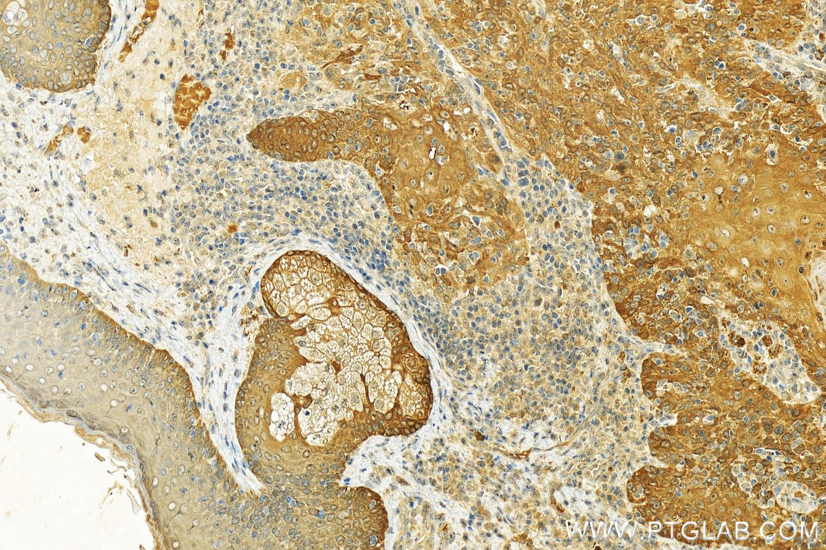 IHC staining of human skin cancer using 15803-1-AP