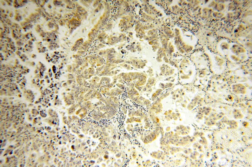 IHC staining of human lung cancer using 17174-1-AP