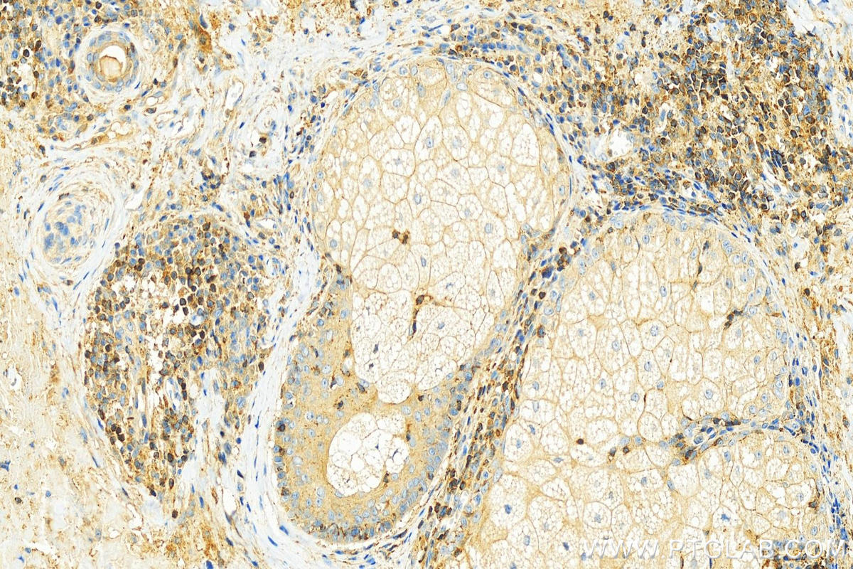 IHC staining of human skin cancer using 66066-1-Ig (same clone as 66066-1-PBS)