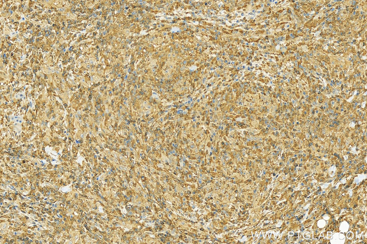 IHC staining of human skin cancer using 25043-1-AP