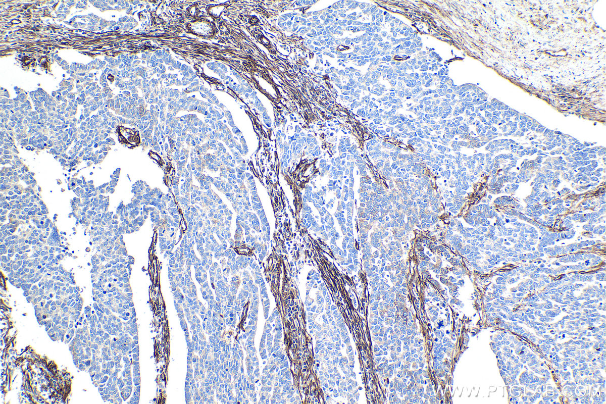 IHC staining of human ovary tumor using 66067-1-Ig (same clone as 66067-1-PBS)