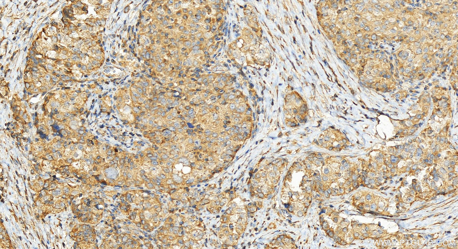 IHC staining of human ovary cancer using 25905-1-AP