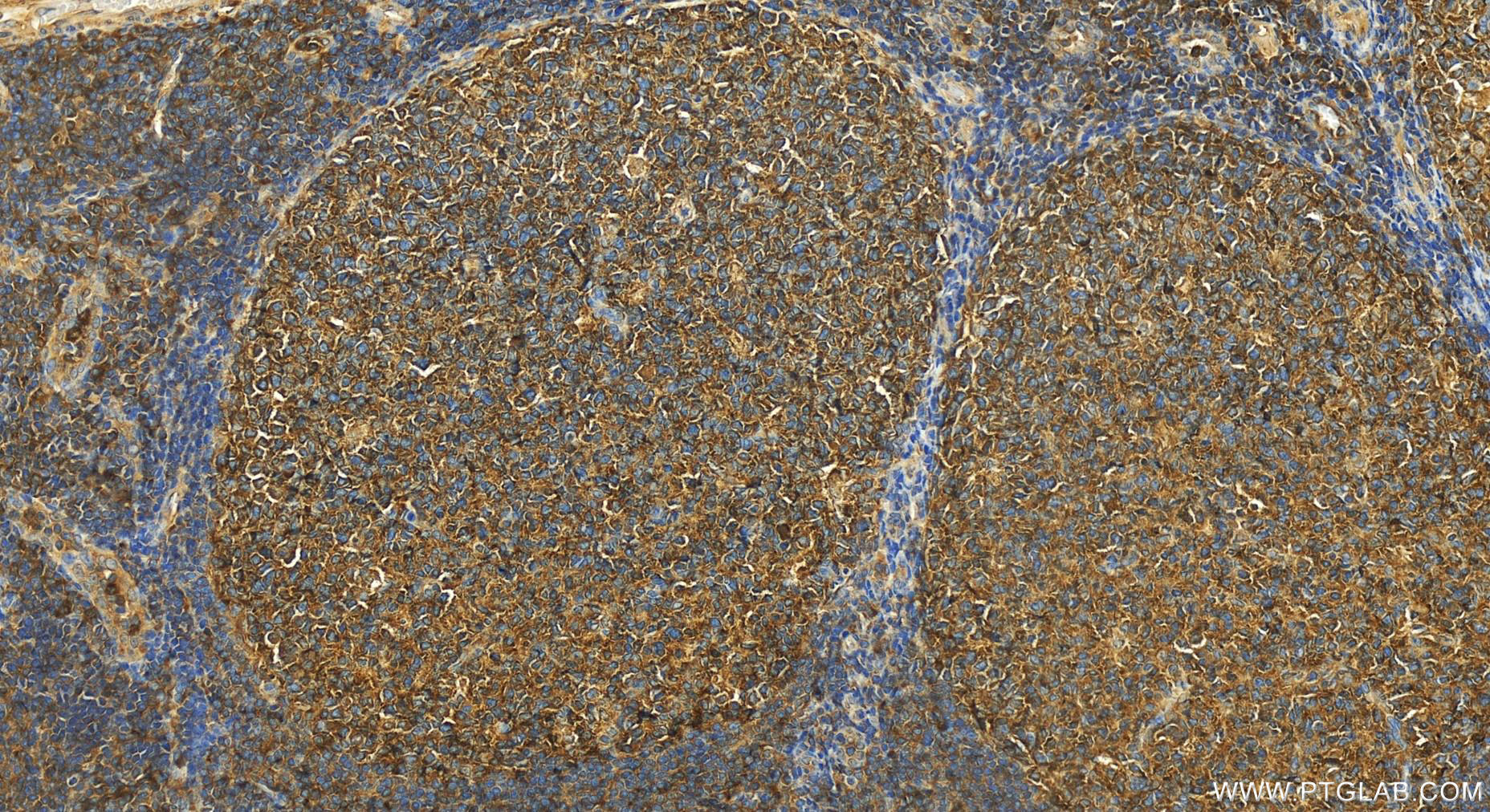 IHC staining of human tonsillitis using 25818-1-AP