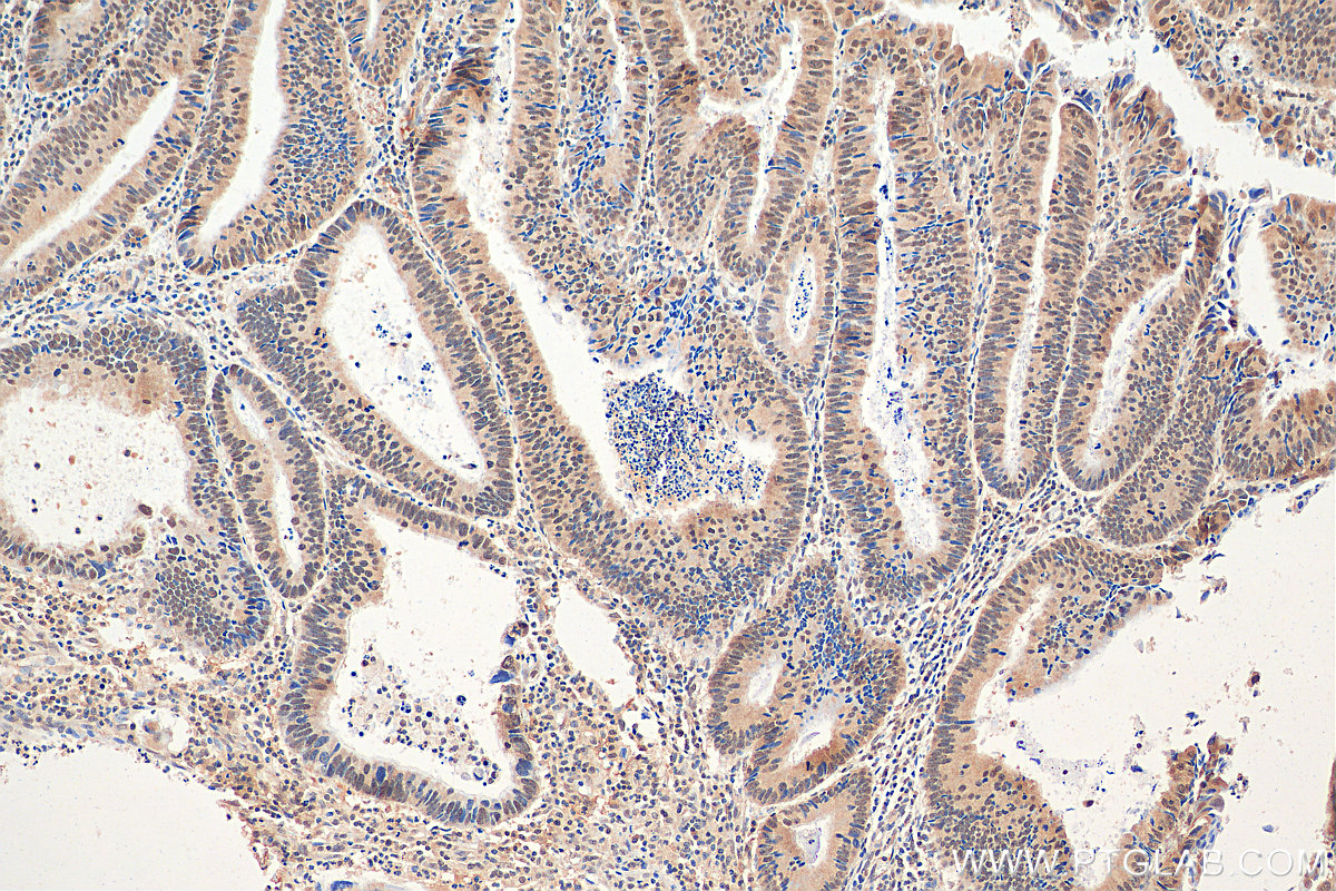 IHC staining of human colon cancer using 21179-1-AP