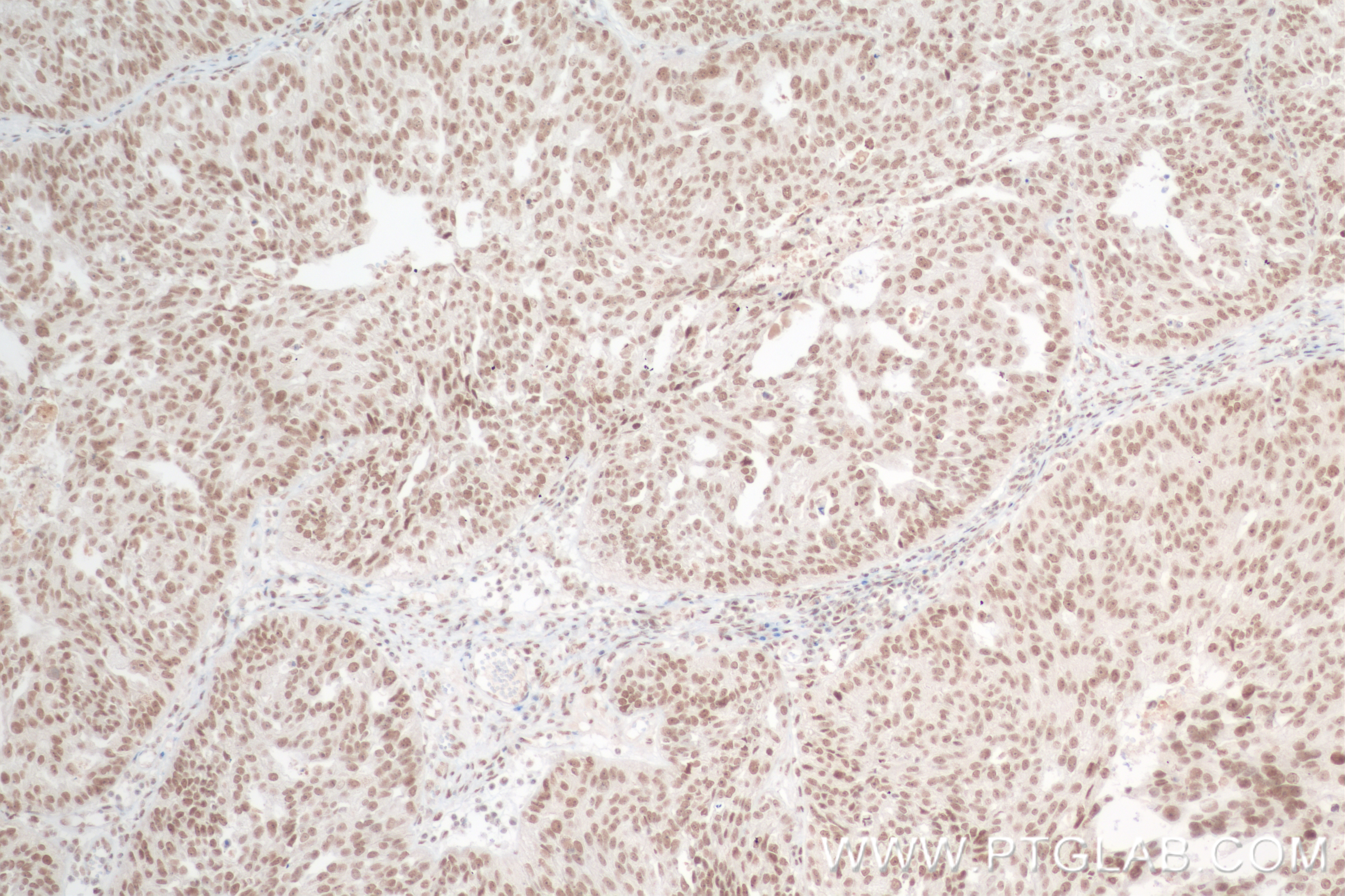 IHC staining of human ovary cancer using 83212-4-RR