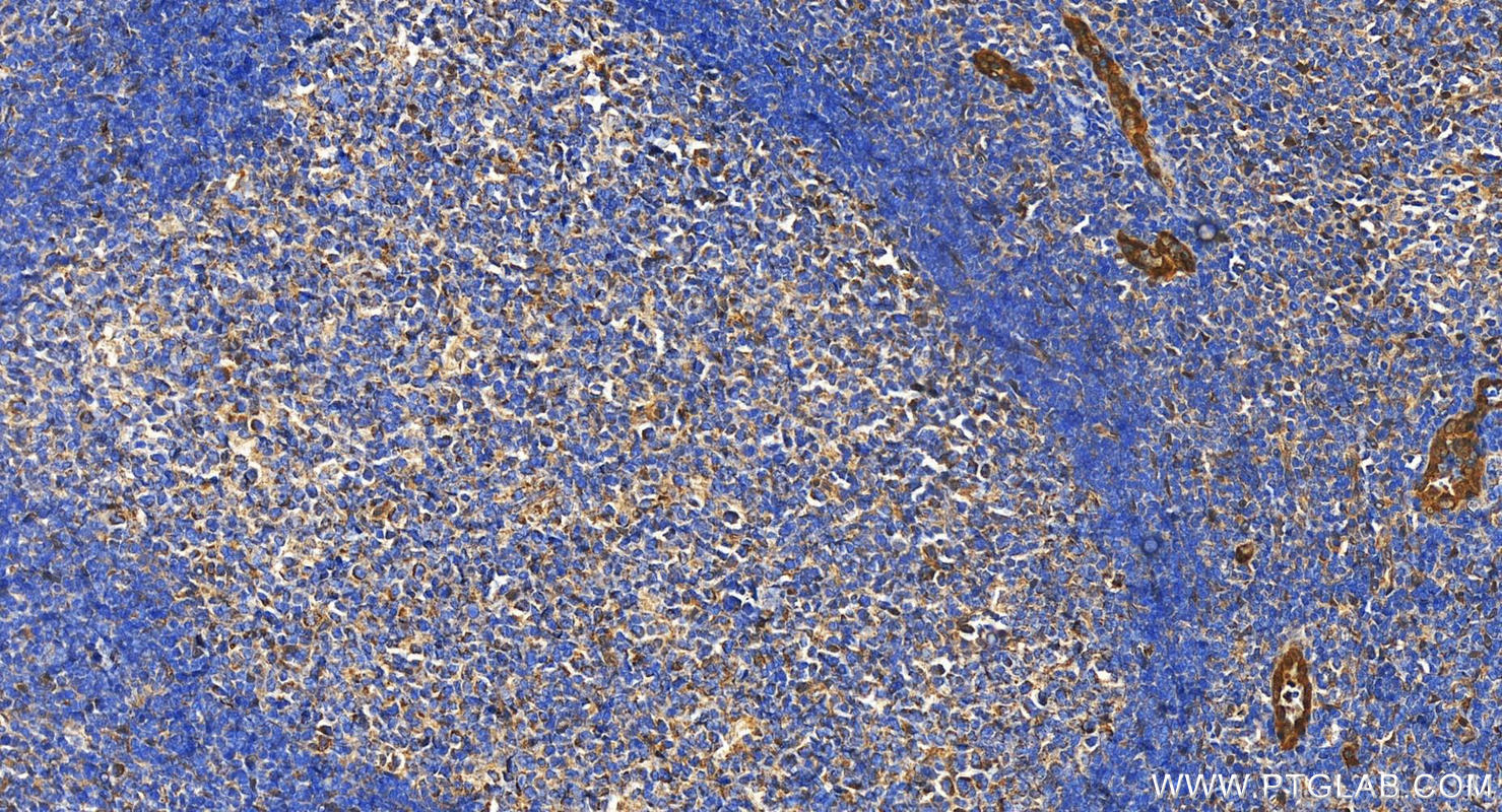 IHC staining of human tonsillitis using 11386-1-AP