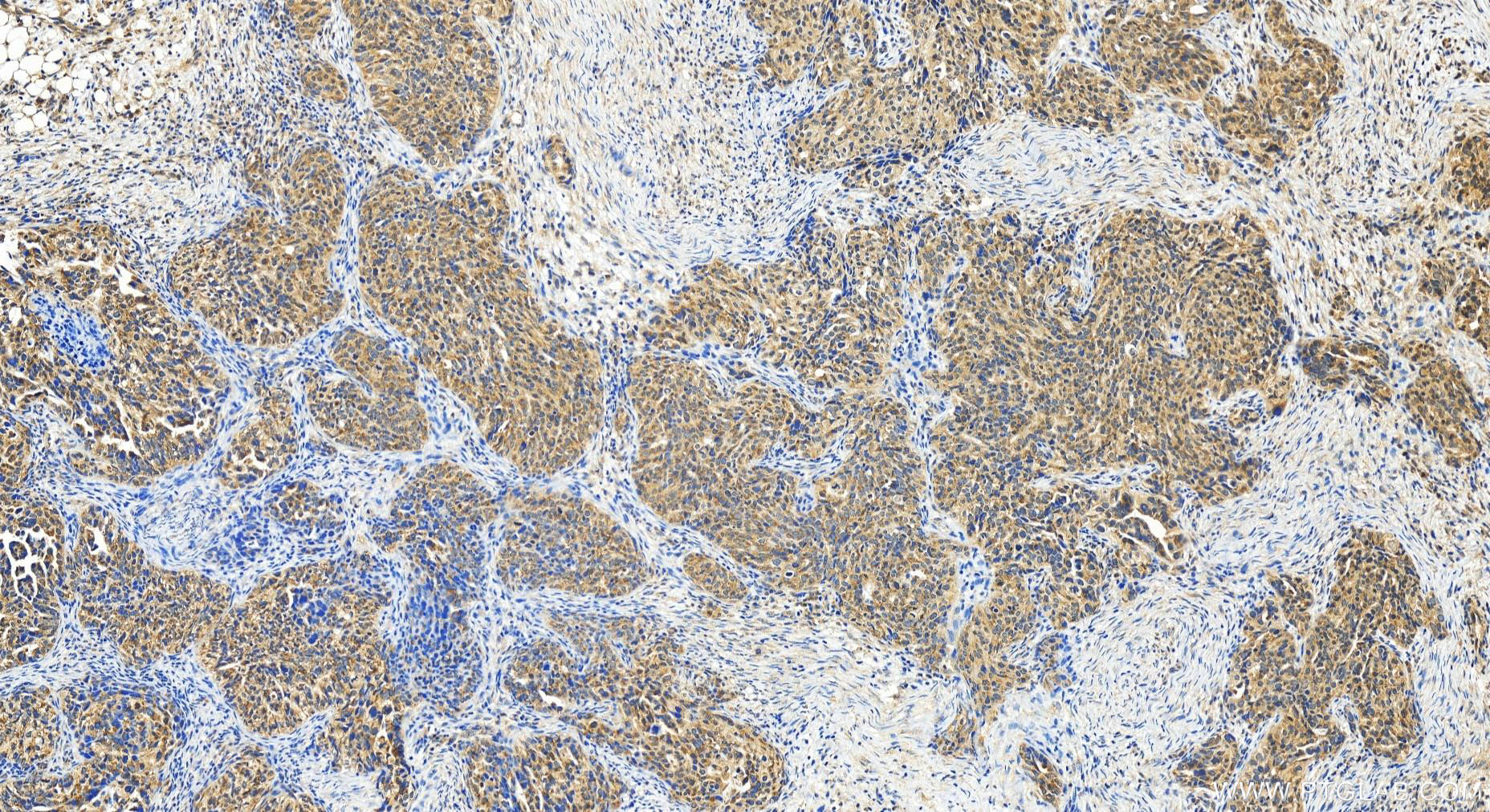 IHC staining of human ovary cancer using 20636-1-AP