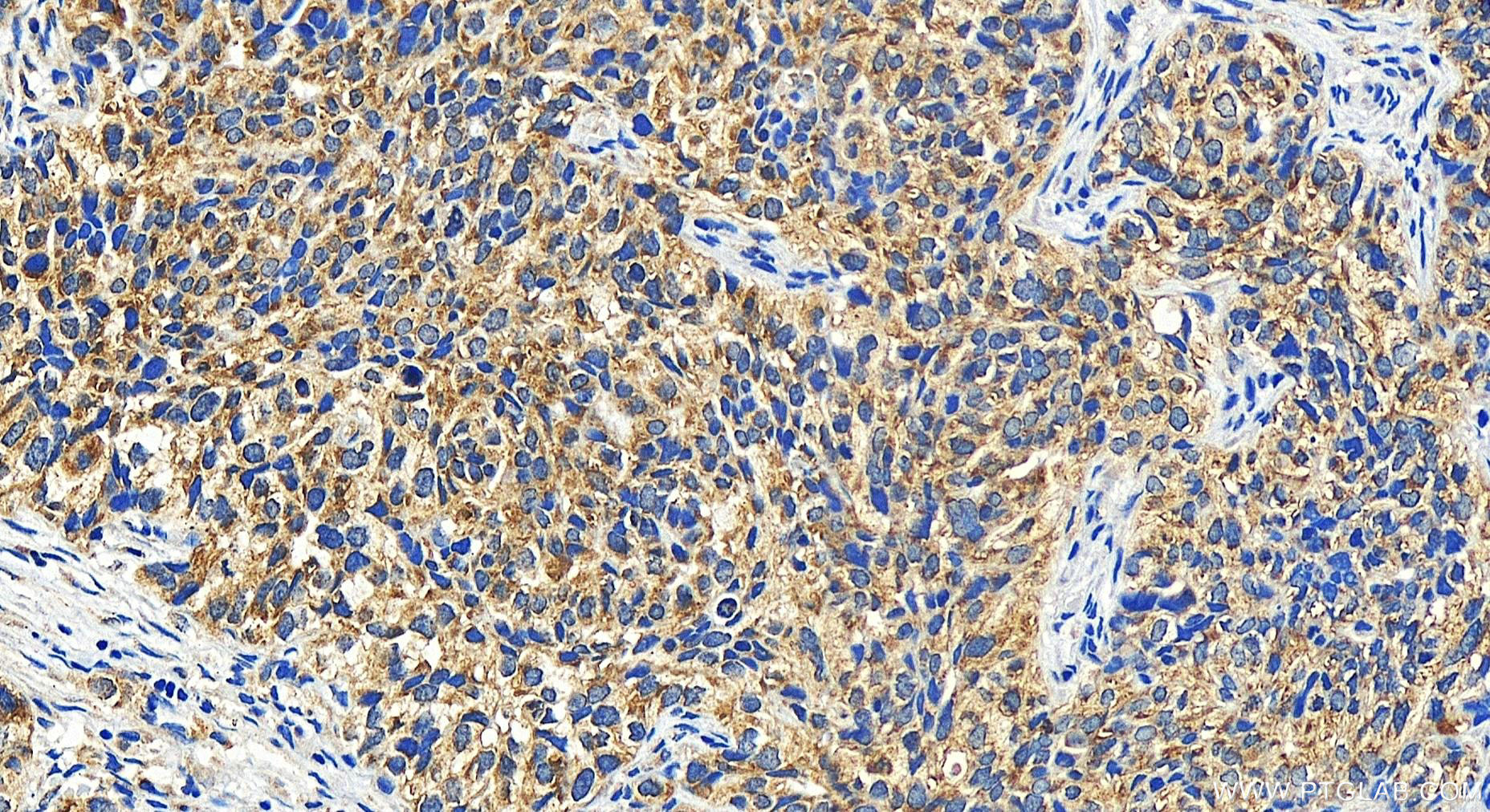 IHC staining of human ovary cancer using 20636-1-AP