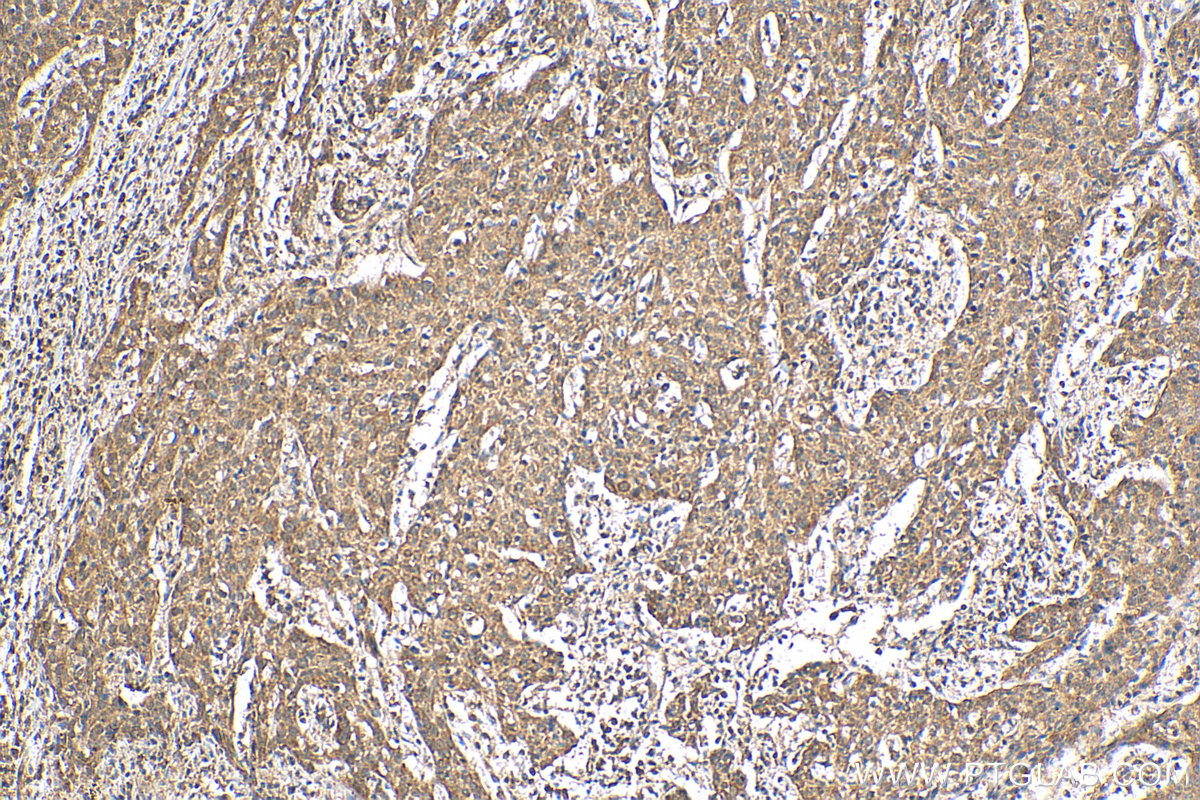 IHC staining of human cervical cancer using 24416-1-AP