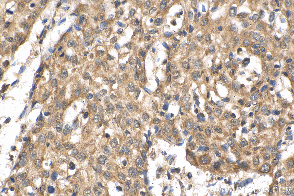 IHC staining of human cervical cancer using 24416-1-AP