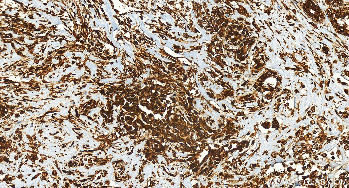 IHC staining of human intrahepatic cholangiocarcinoma using 83580-5-RR