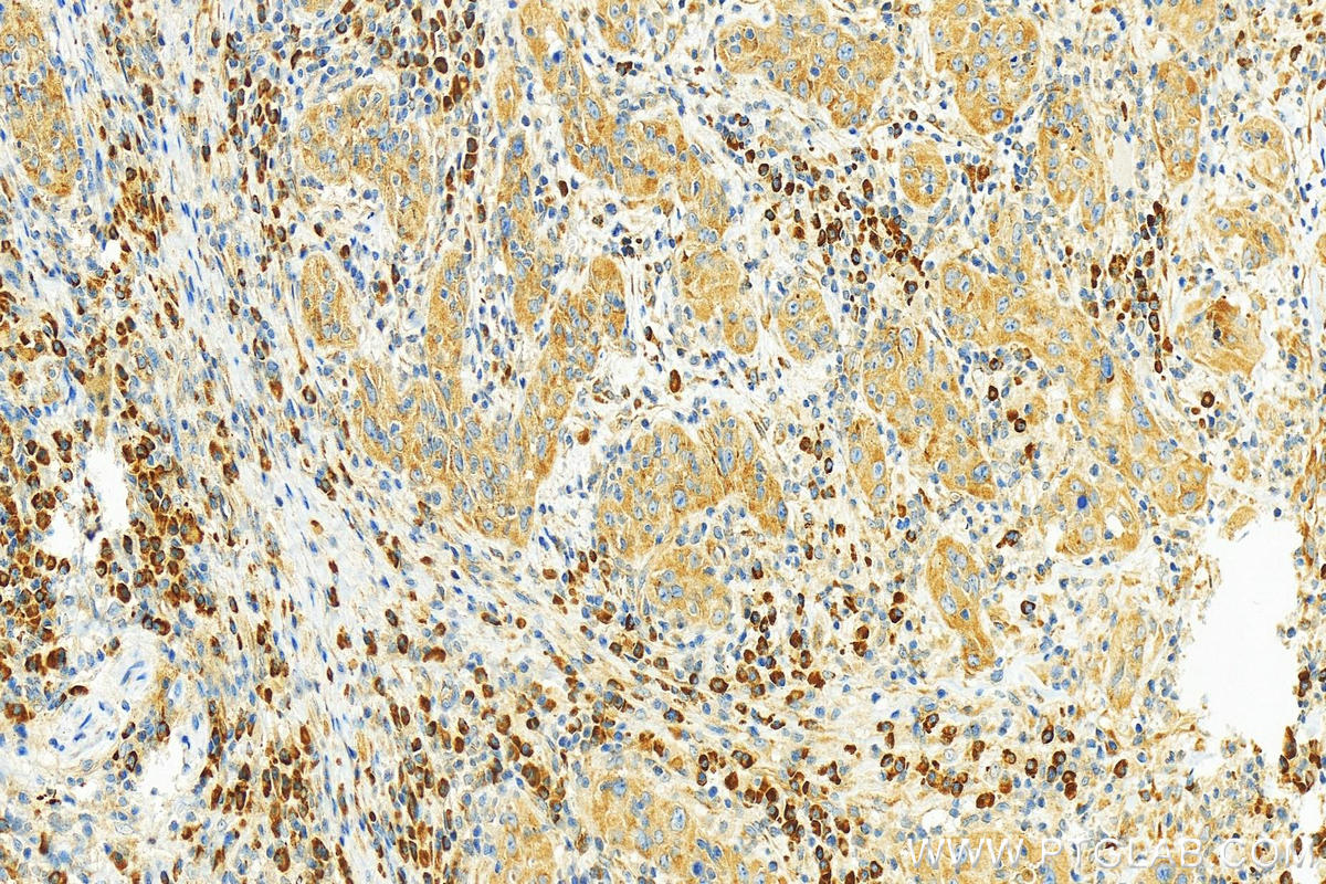 IHC staining of human skin cancer using 55004-1-AP