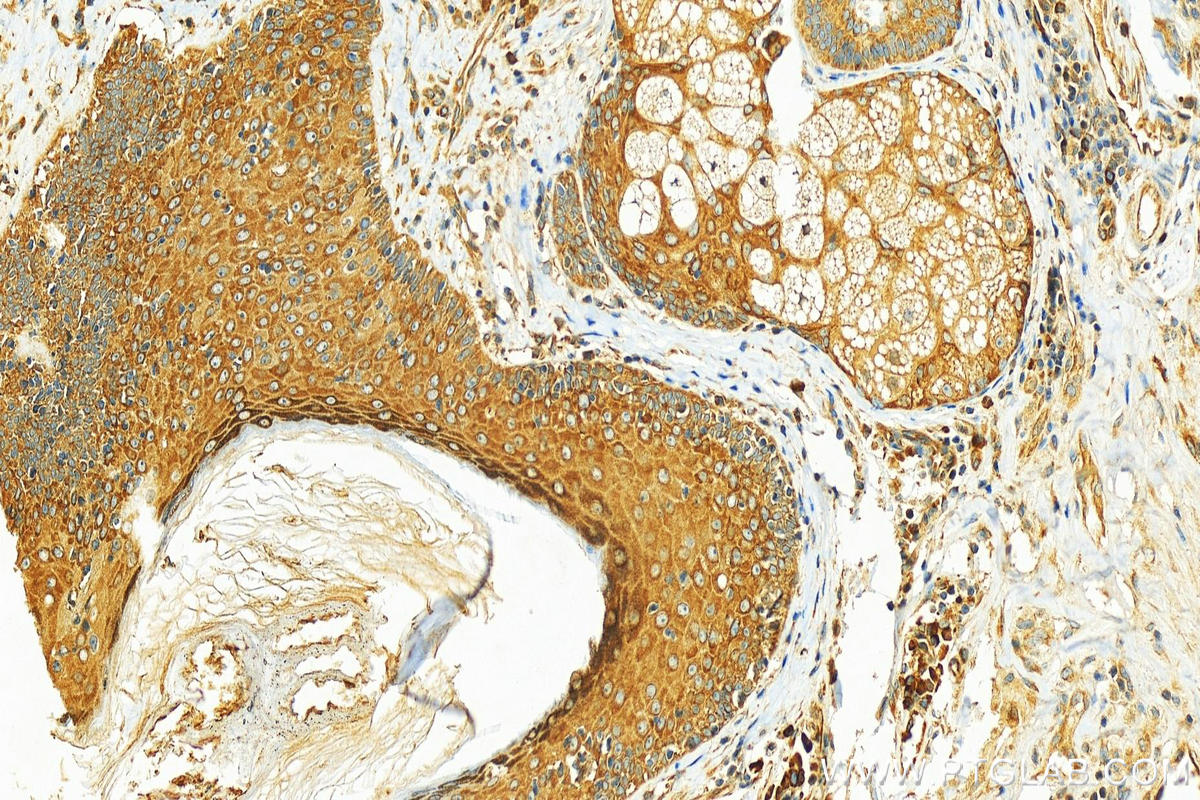 IHC staining of human skin cancer using 55004-1-AP